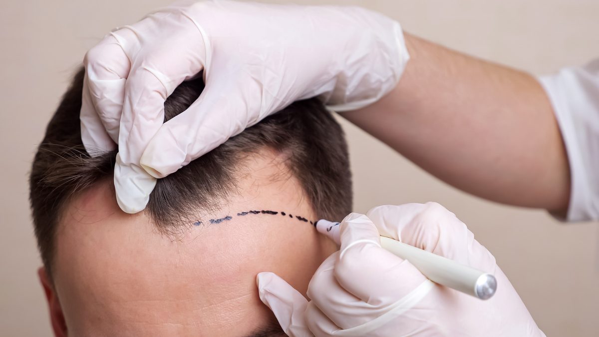 Hair transplant at SaluVista
