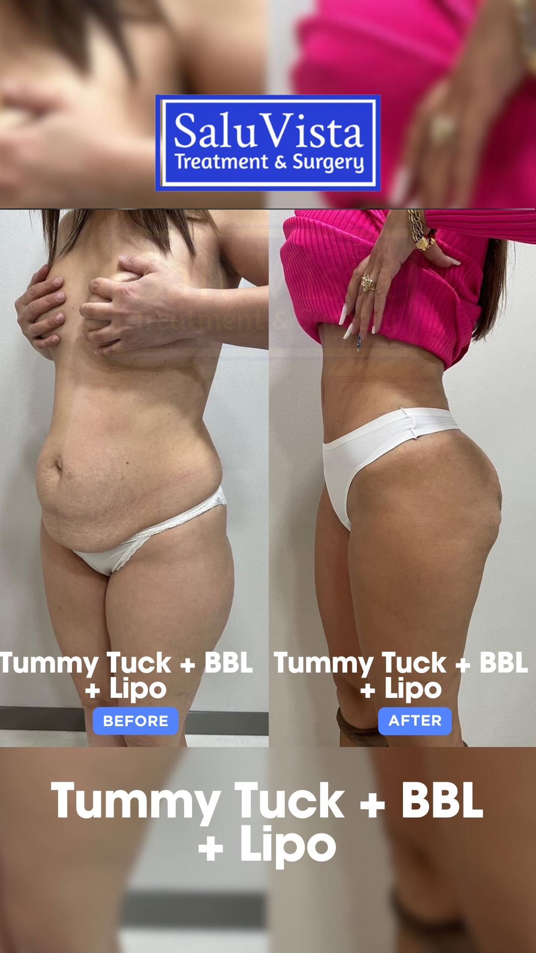 Tummy tuck + BBL + lipo before and after result