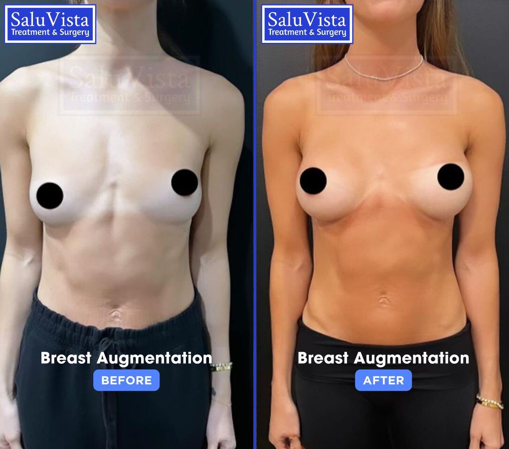 Breast augmentation before and after result