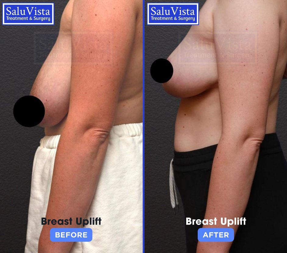 Breast uplift before and after result