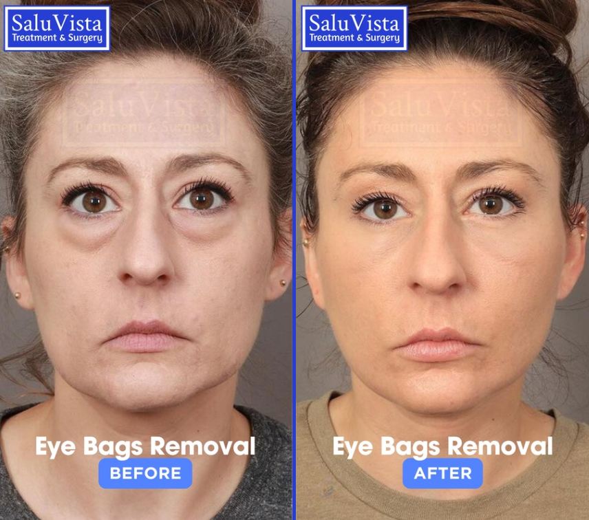 Eye bag removal before and after result