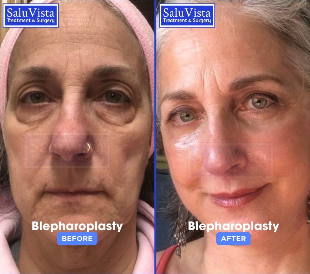 Blepharoplasty before and after result