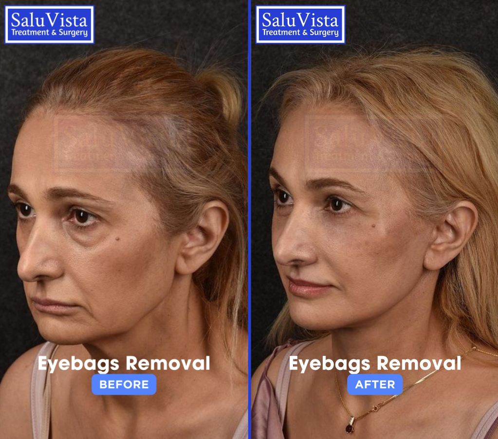 Eye bag removal before and after result