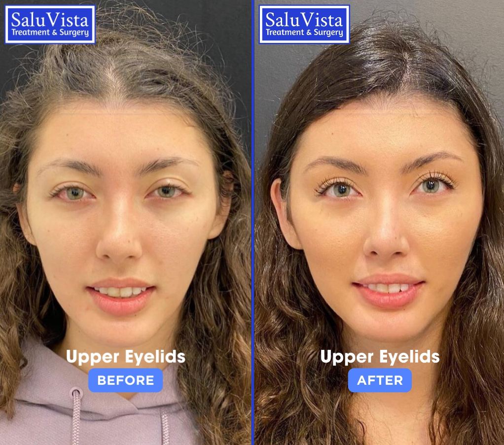 Upper eyelid surgery before and after result