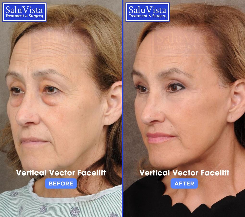 Vertical vector facelift before and after result