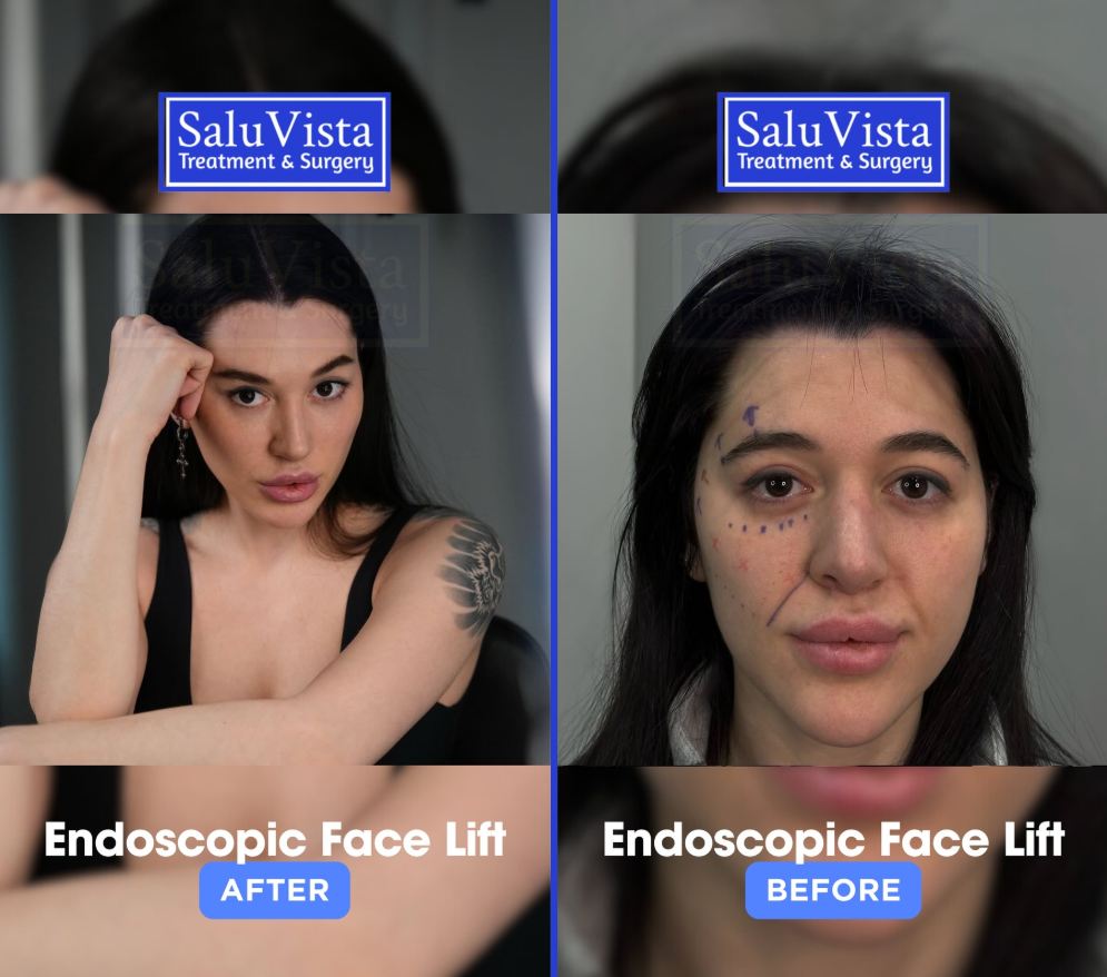 Endoscopic facelift before and after result