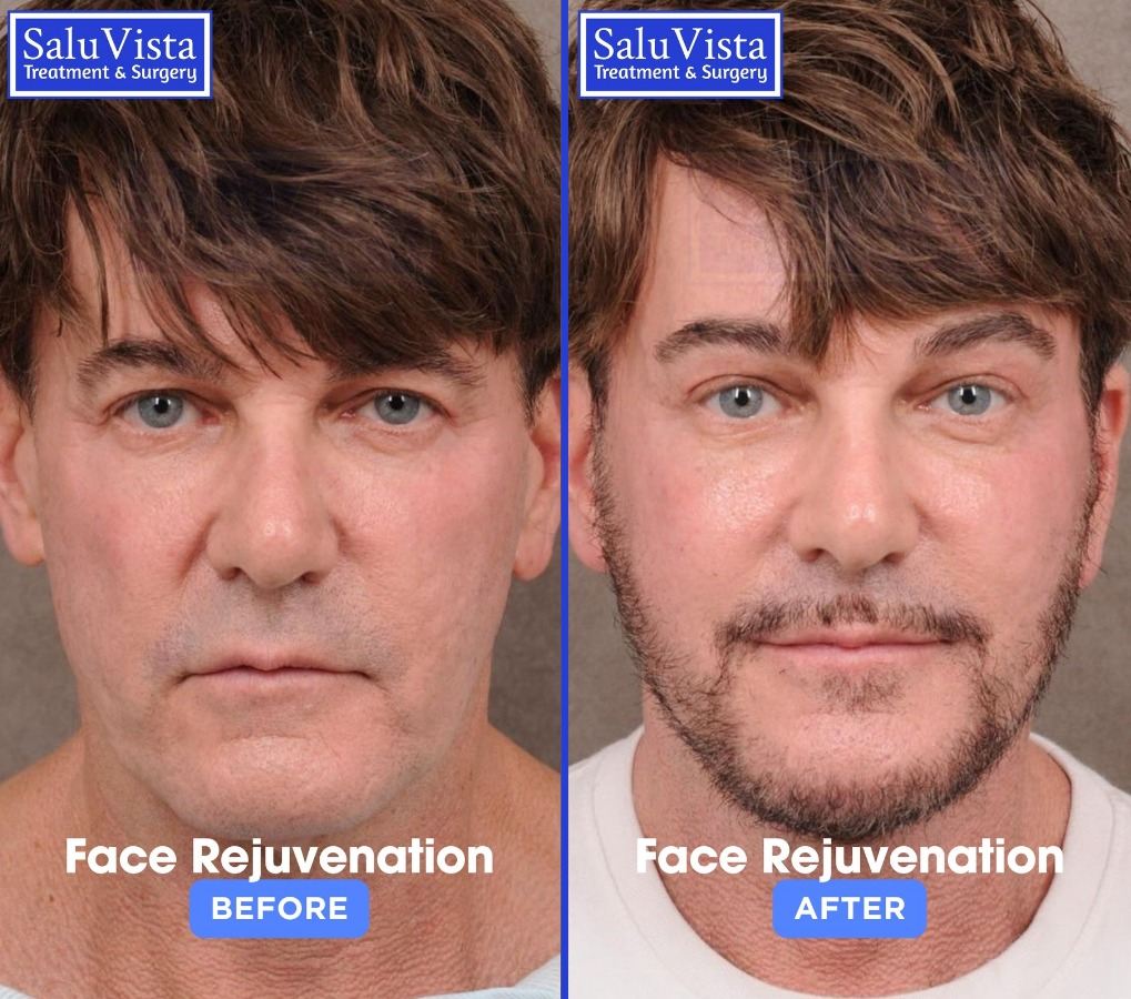 Face rejuvenation before and after result