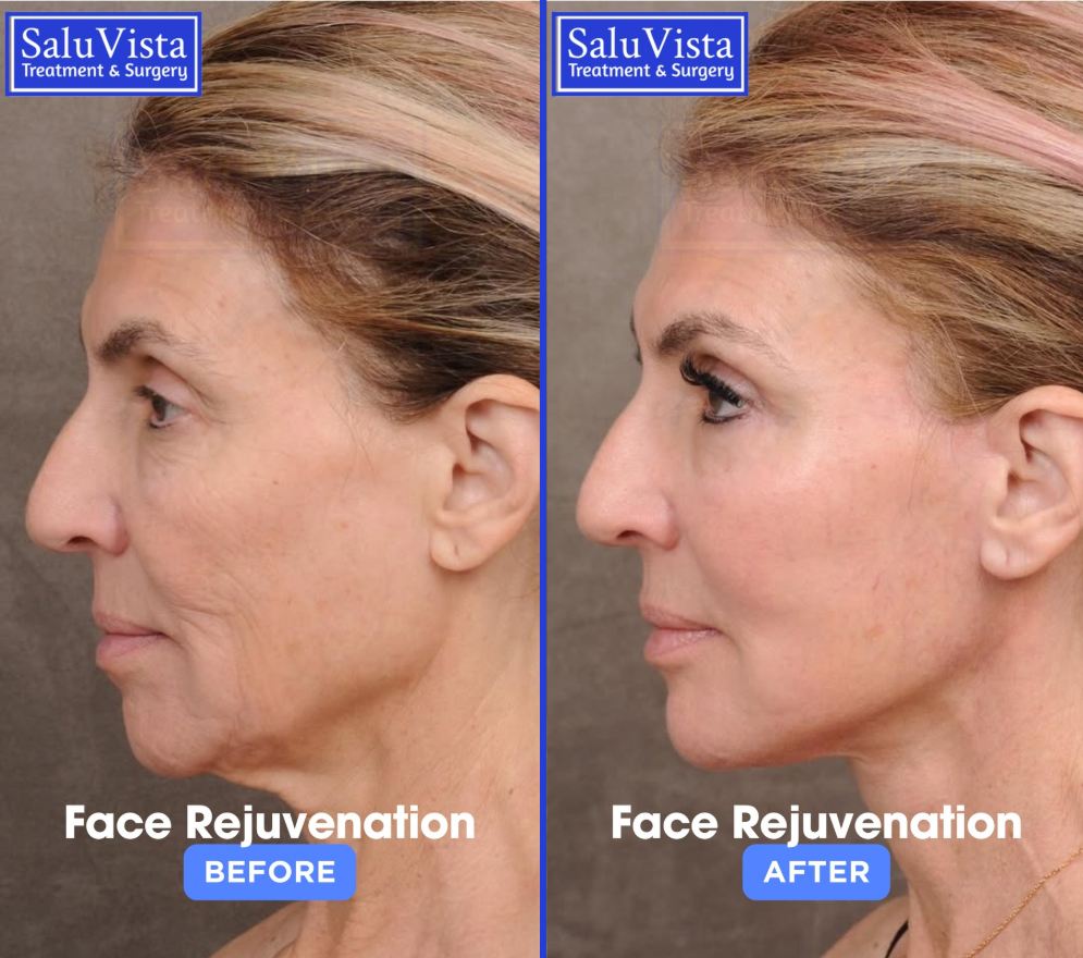Face rejuvenation before and after result