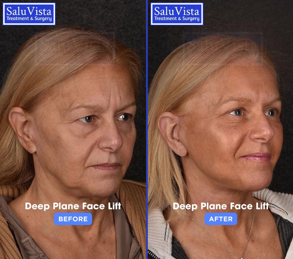 Deep plane facelift before and after result