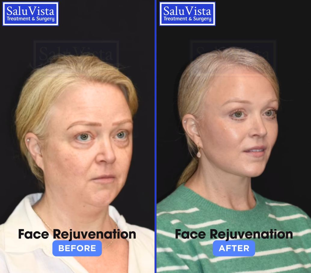 Face rejuvenation before and after result