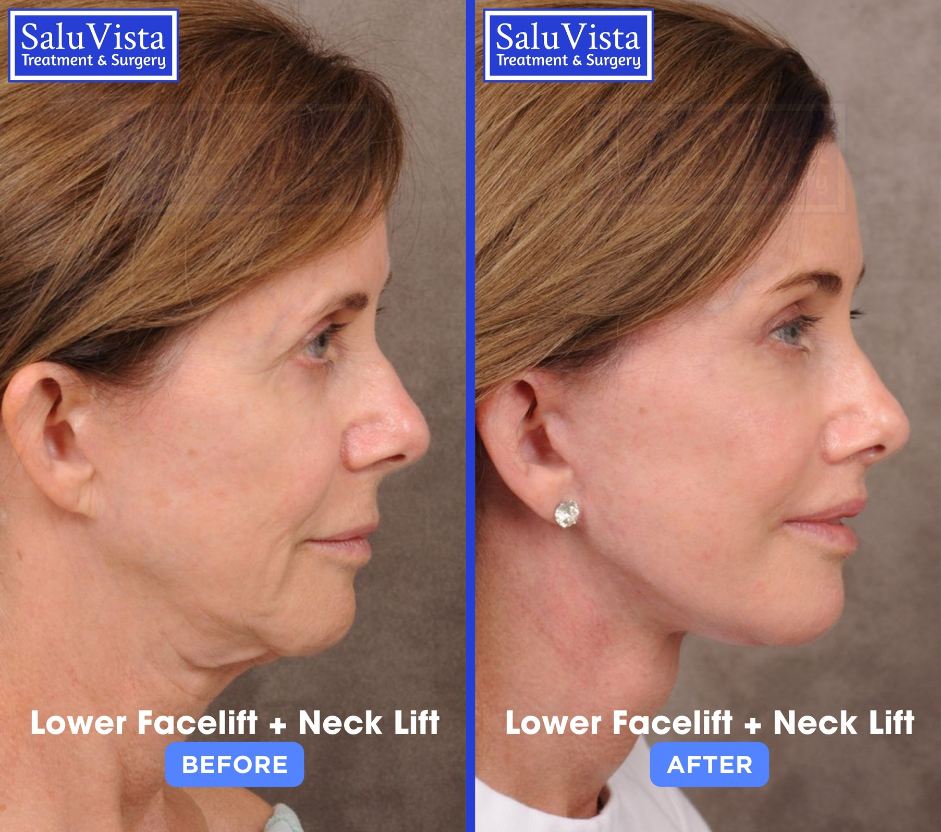 Lower facelift + neck lift before and after result