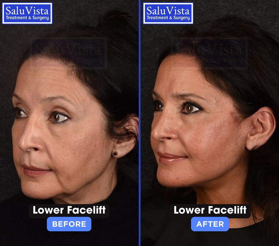 Lower facelift before and after result
