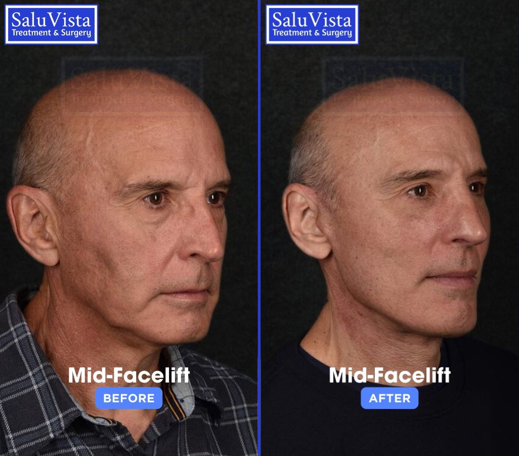 Mid-facelift before and after result