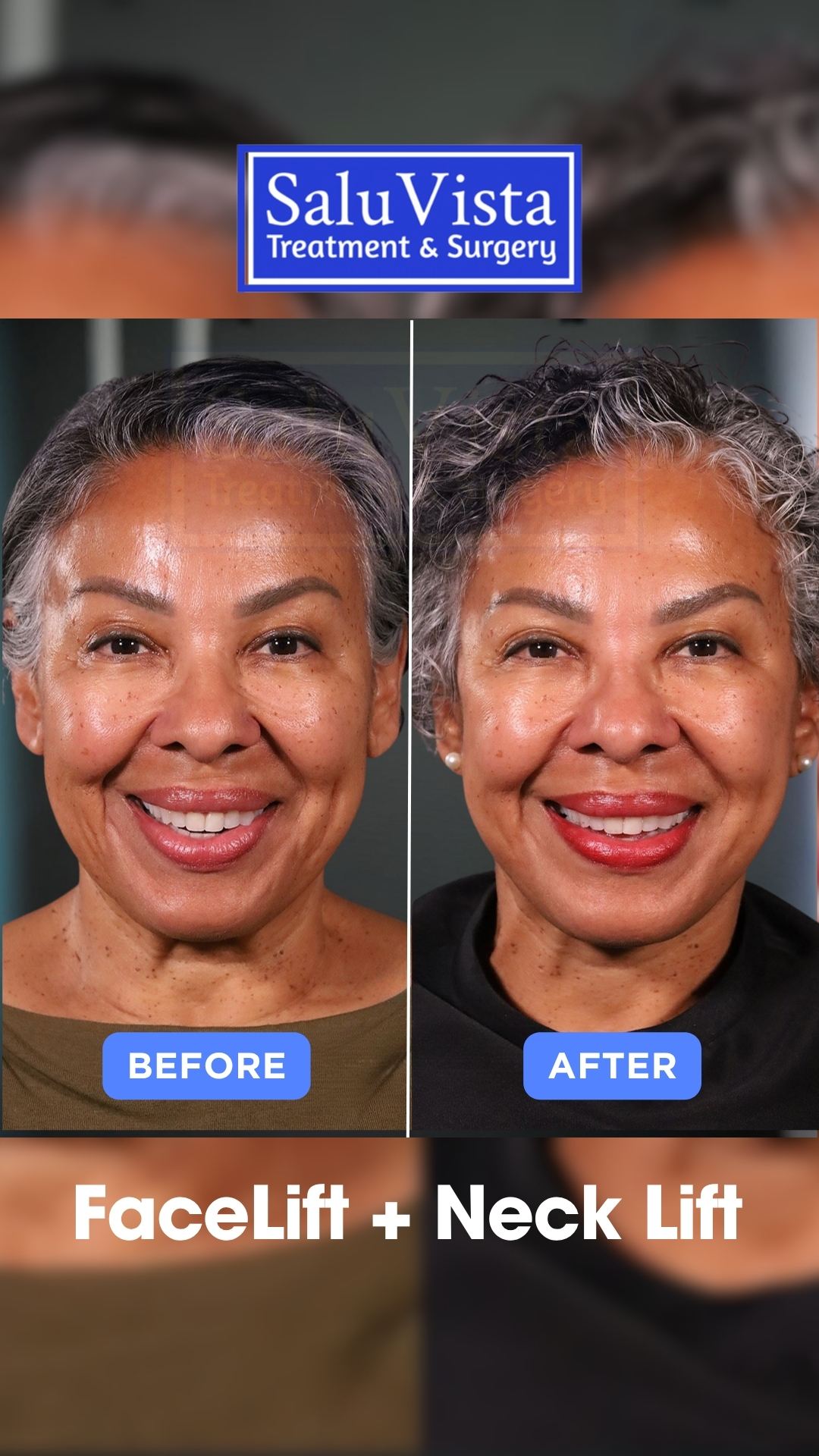 Facelift + neck lift before and after result