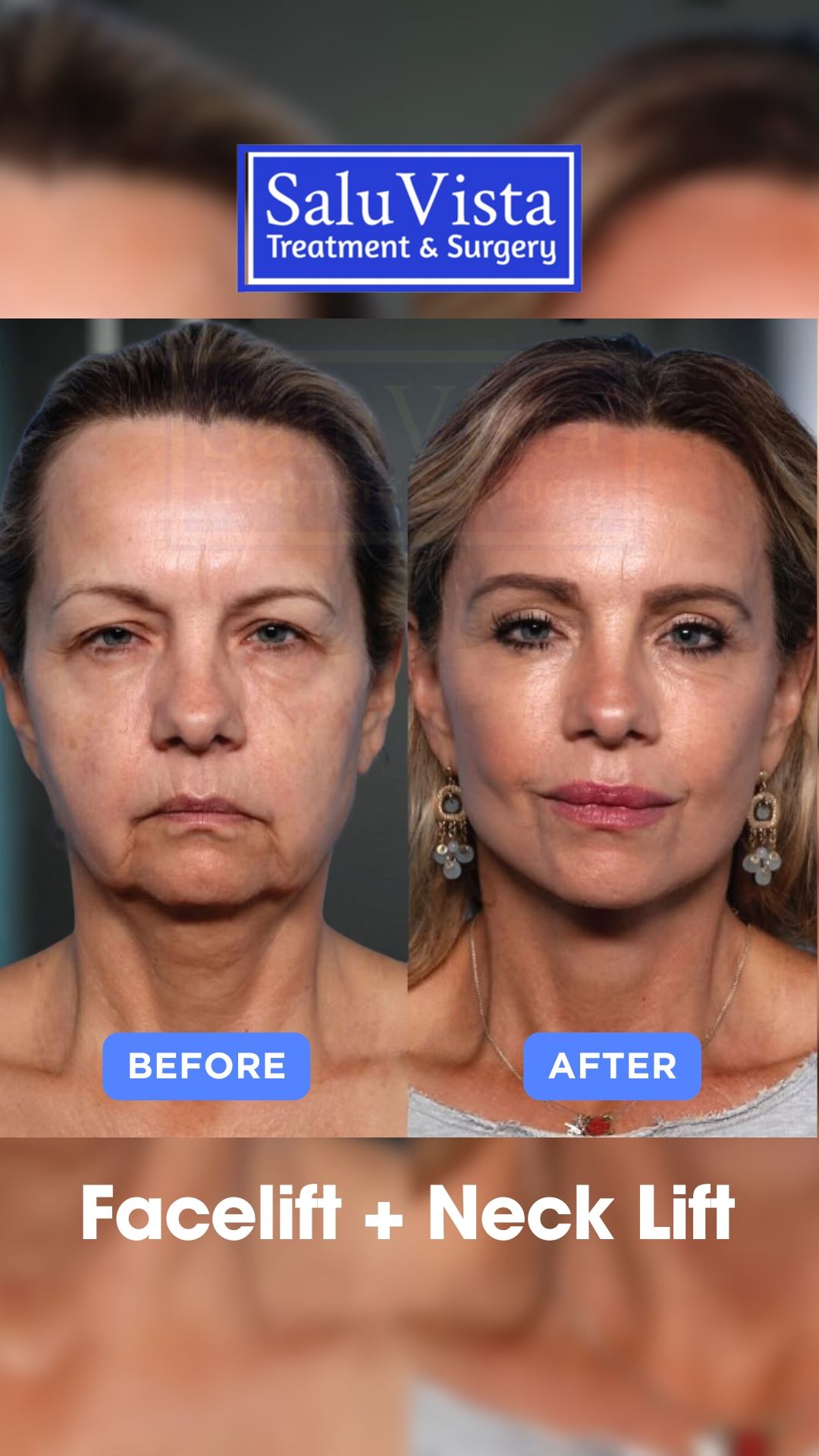 Facelift + neck lift before and after result