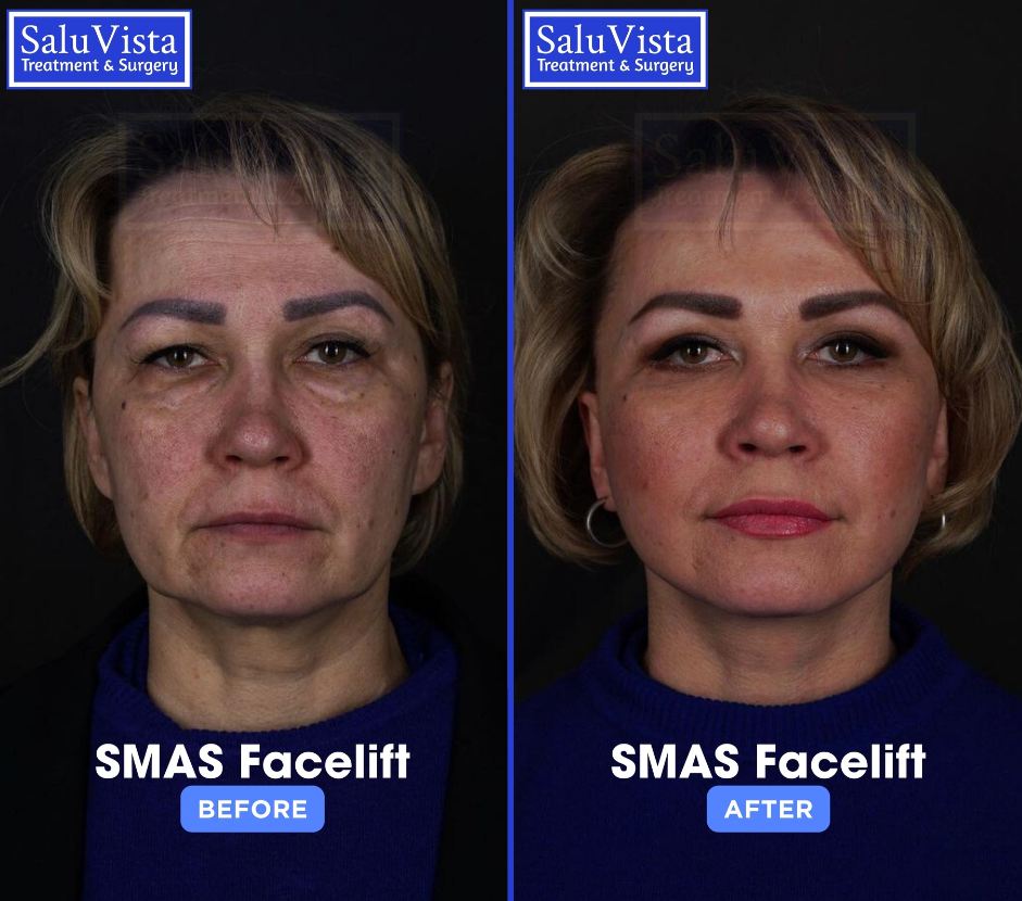 SMAS facelift before and after result