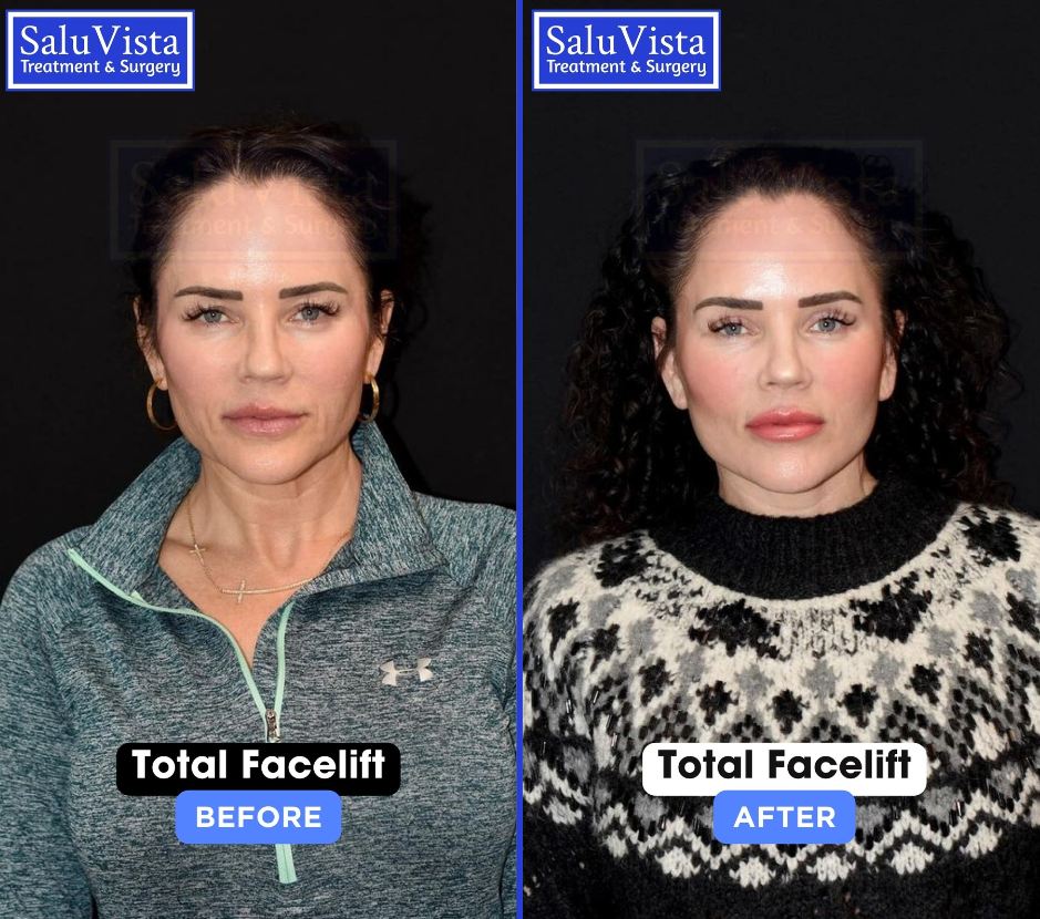 Total facelift before and after result