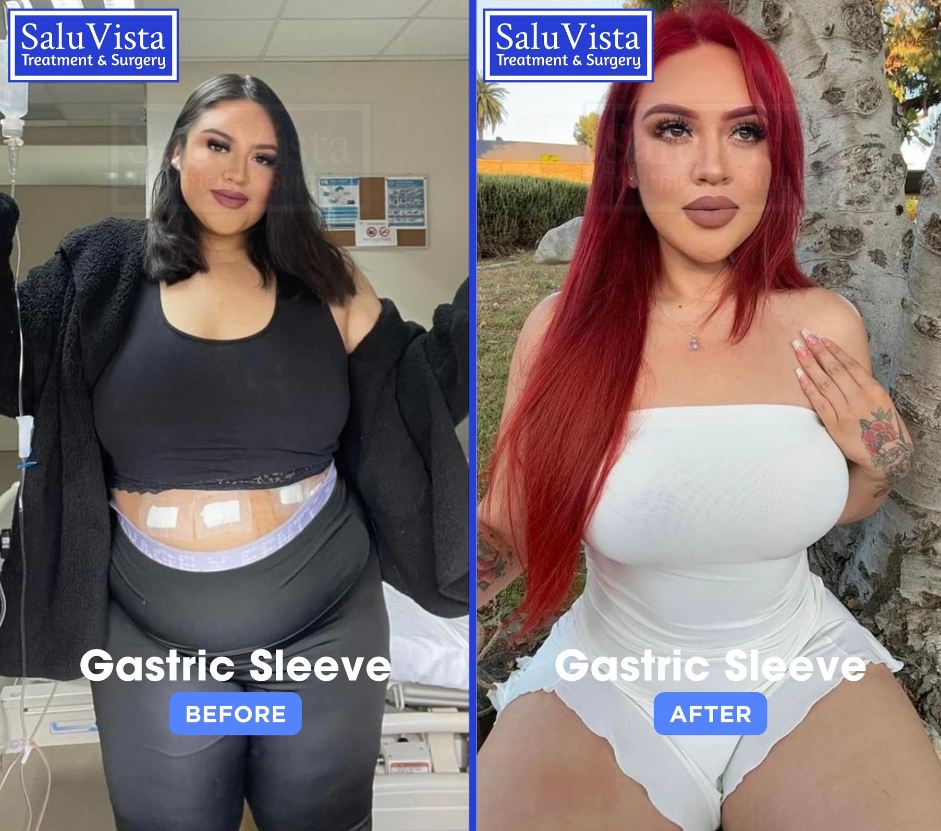 Gastric sleeve before and after result