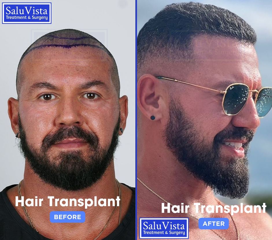 Hair transplant before and after result
