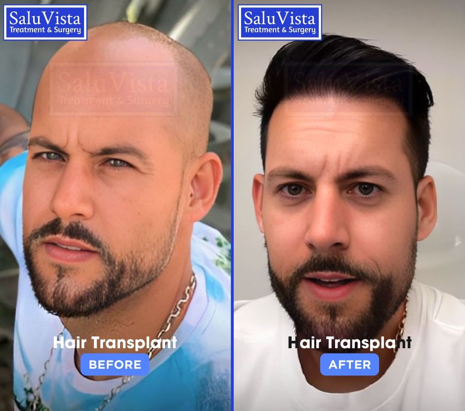 Hair transplant before and after result