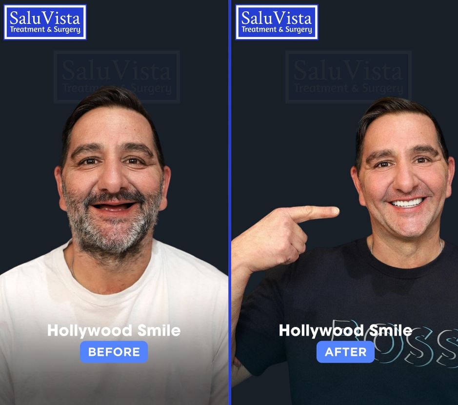 Hollywood smile before and after result