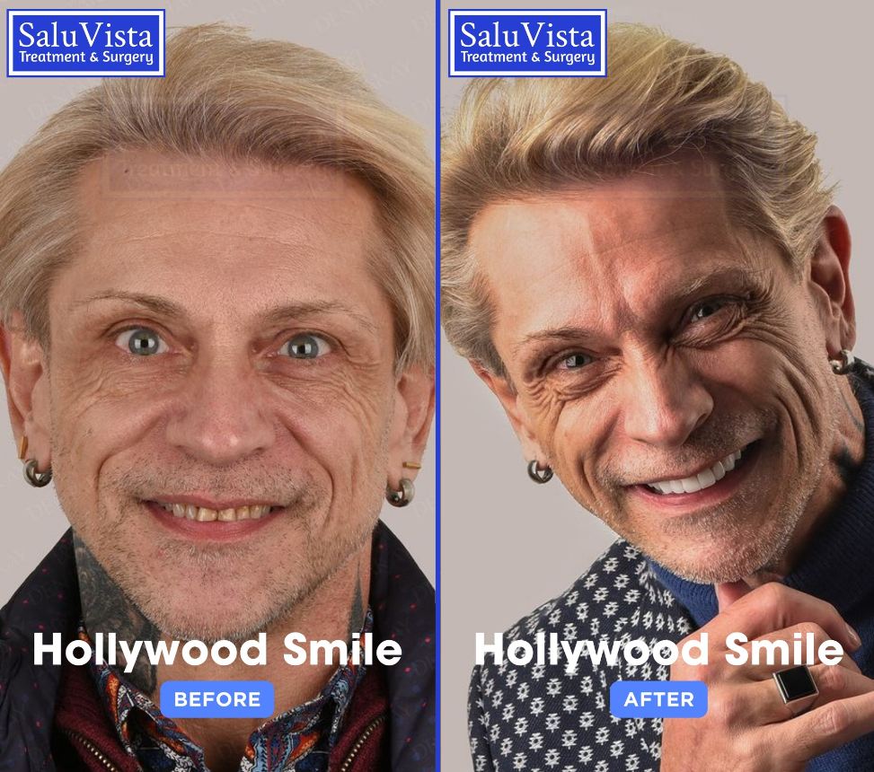 Hollywood smile before and after result