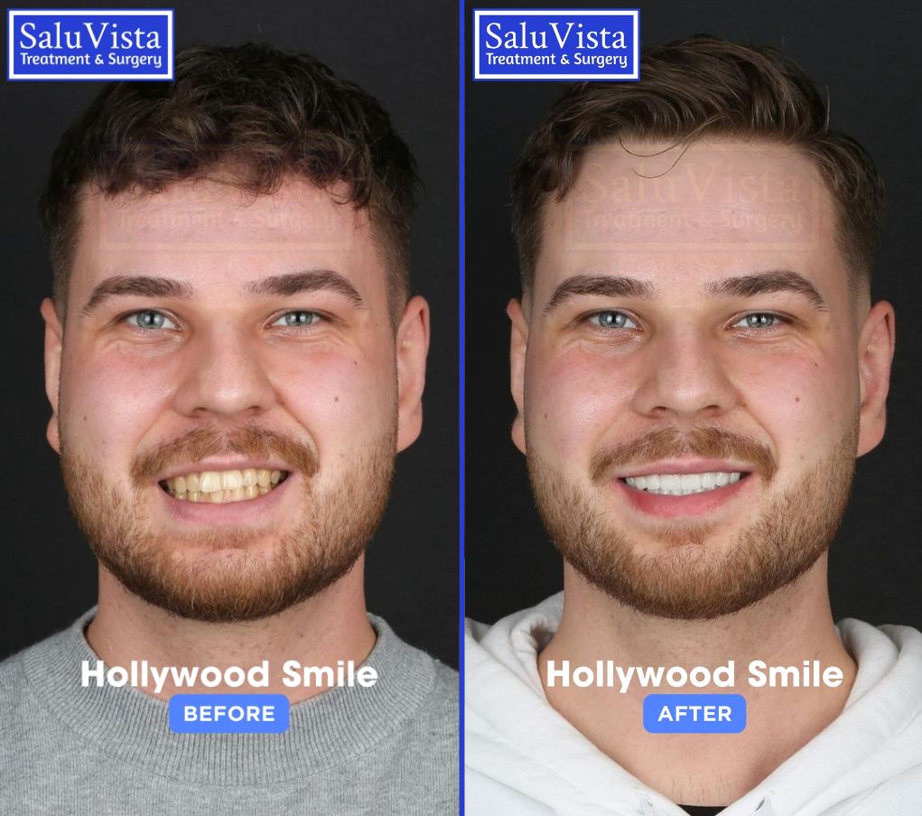 Hollywood smile before and after result