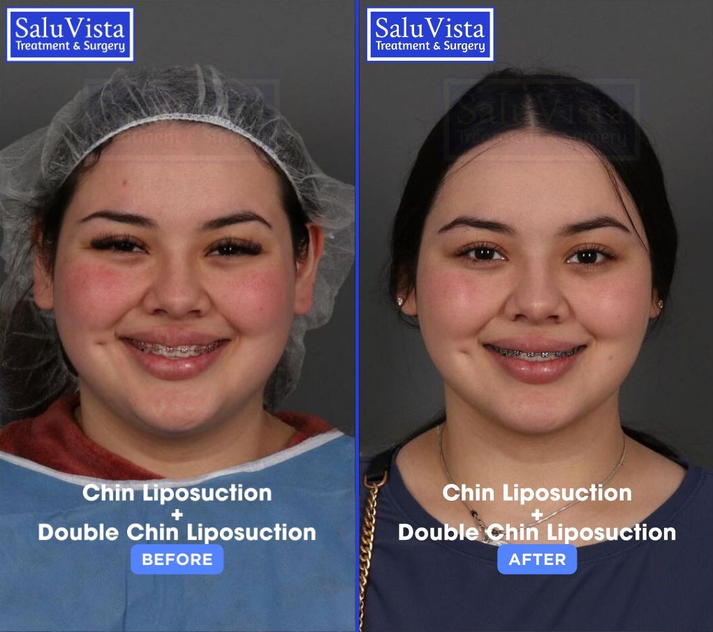 Chin liposuction before and after result