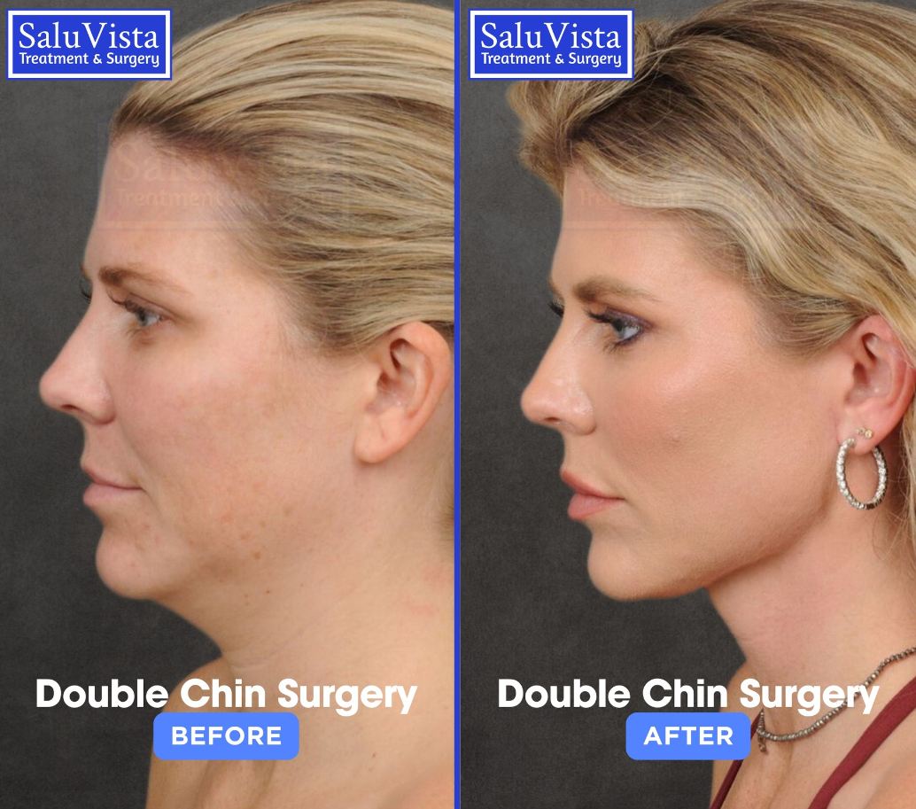 Double chin surgery before and after result