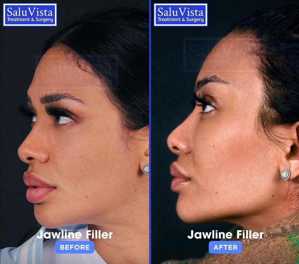 Jawline filler before and after result
