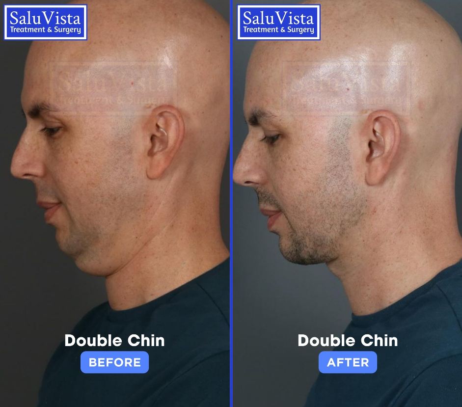 Double chin removal before and after result