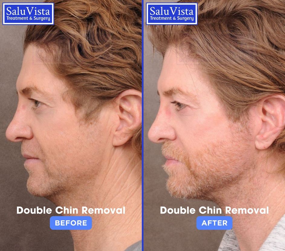 Double chin removal before and after result