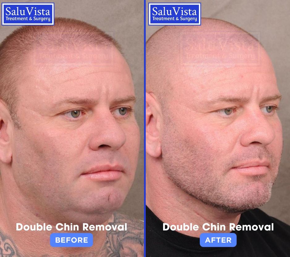 Double chin removal before and after result