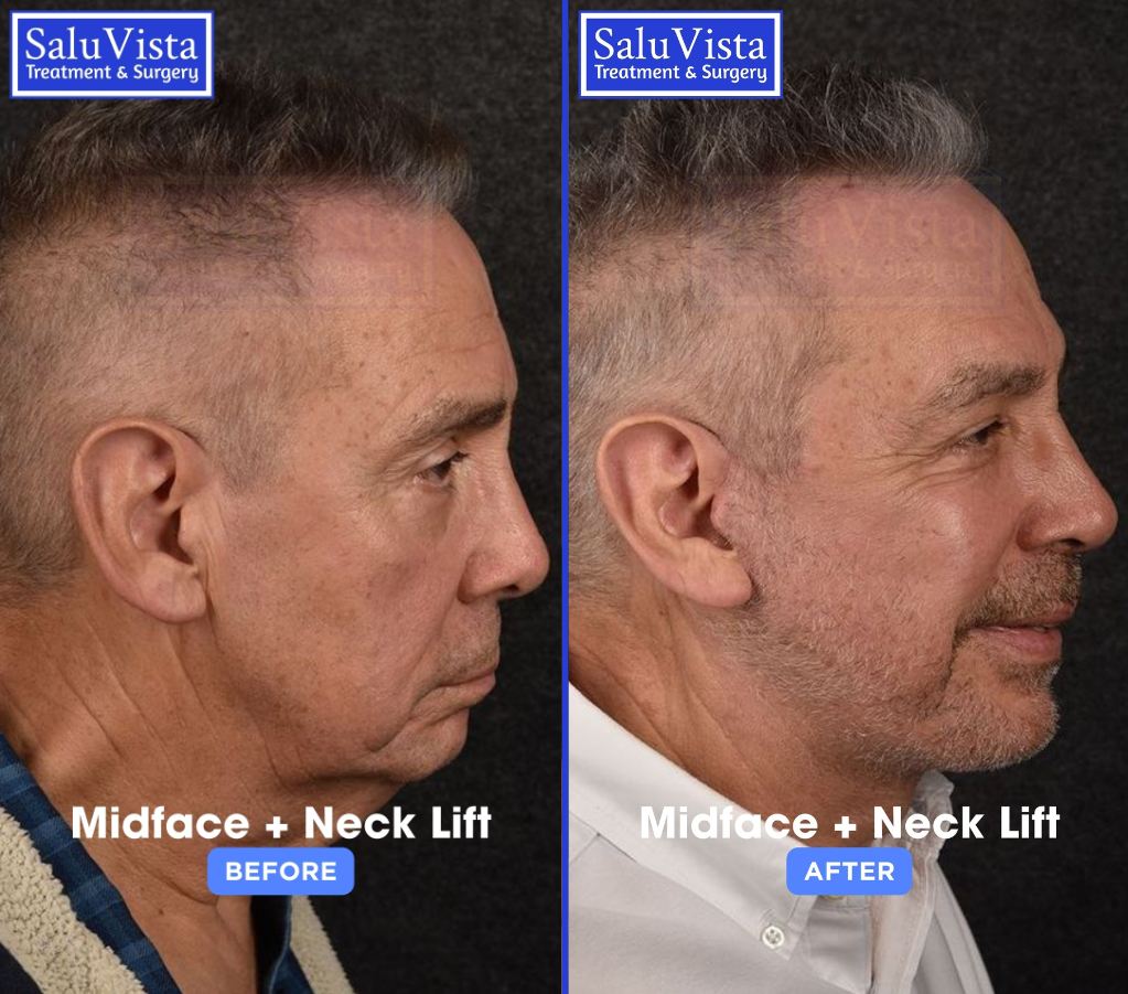 Midface + neck lift before and after result