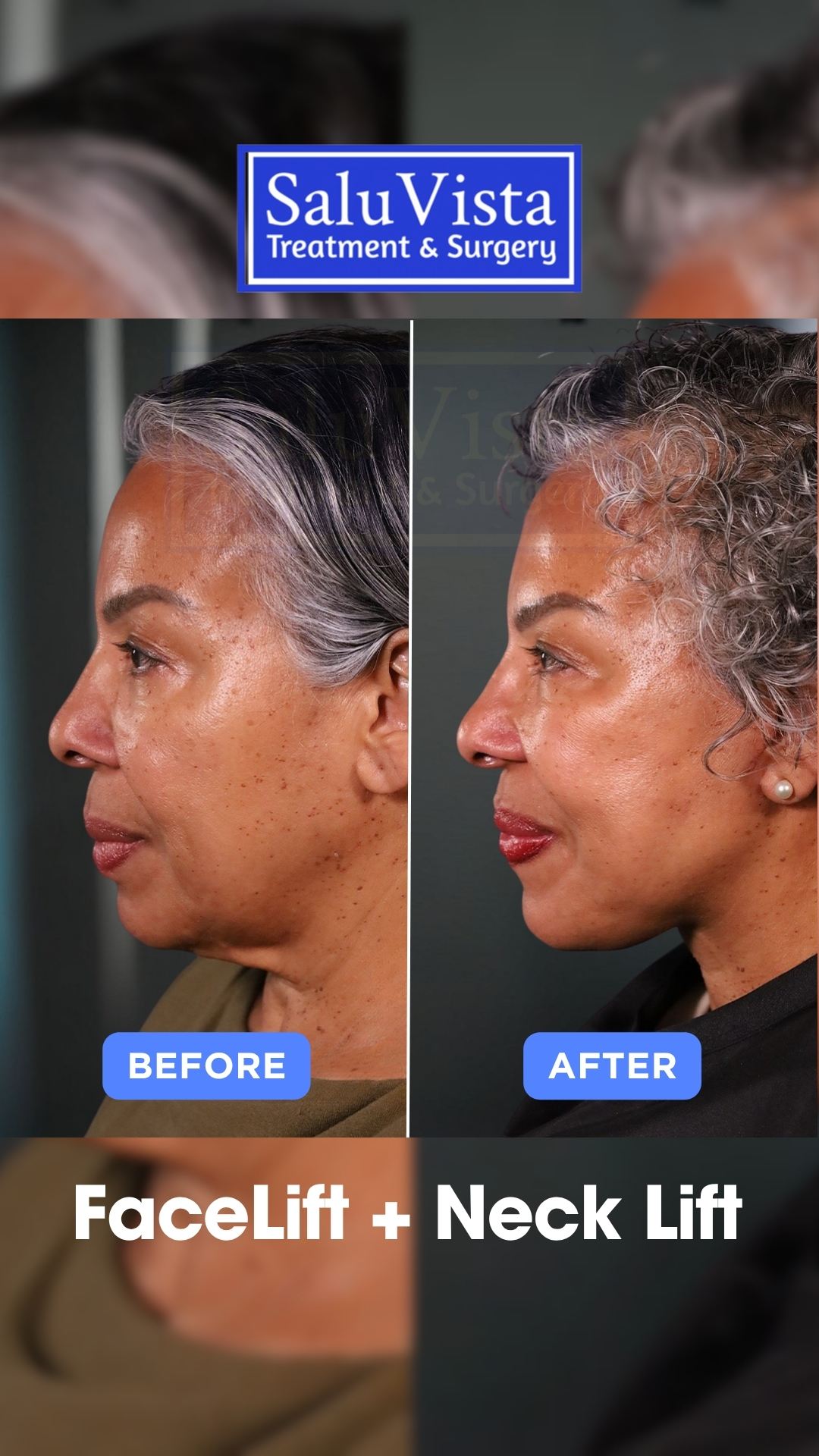 Facelift + neck lift before and after result