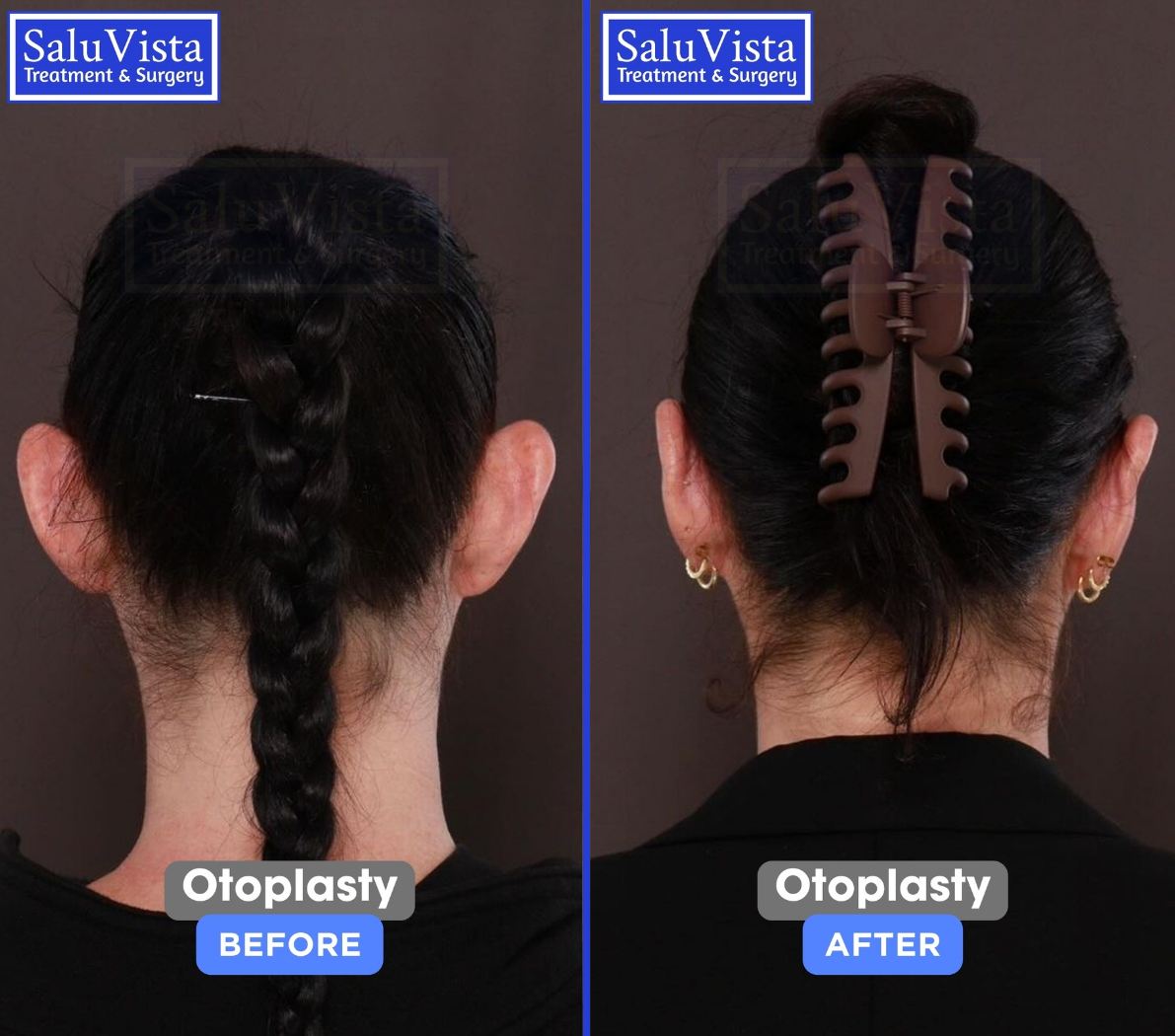 Otoplasty before and after result