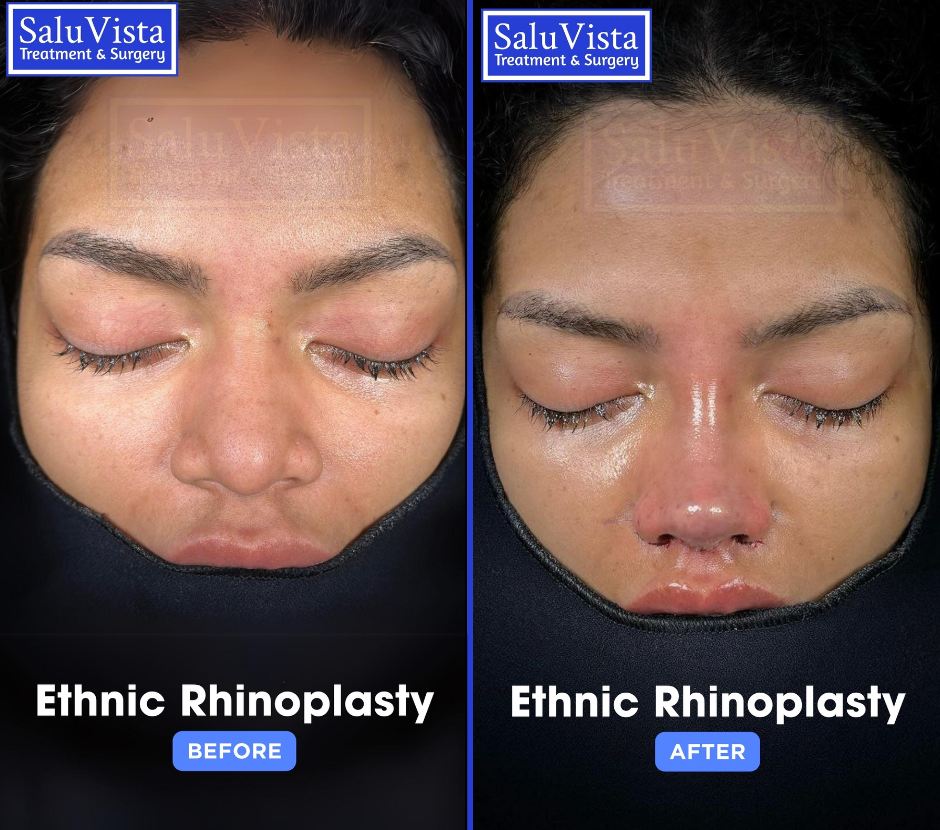 Ethnic rhinoplasty before and after result