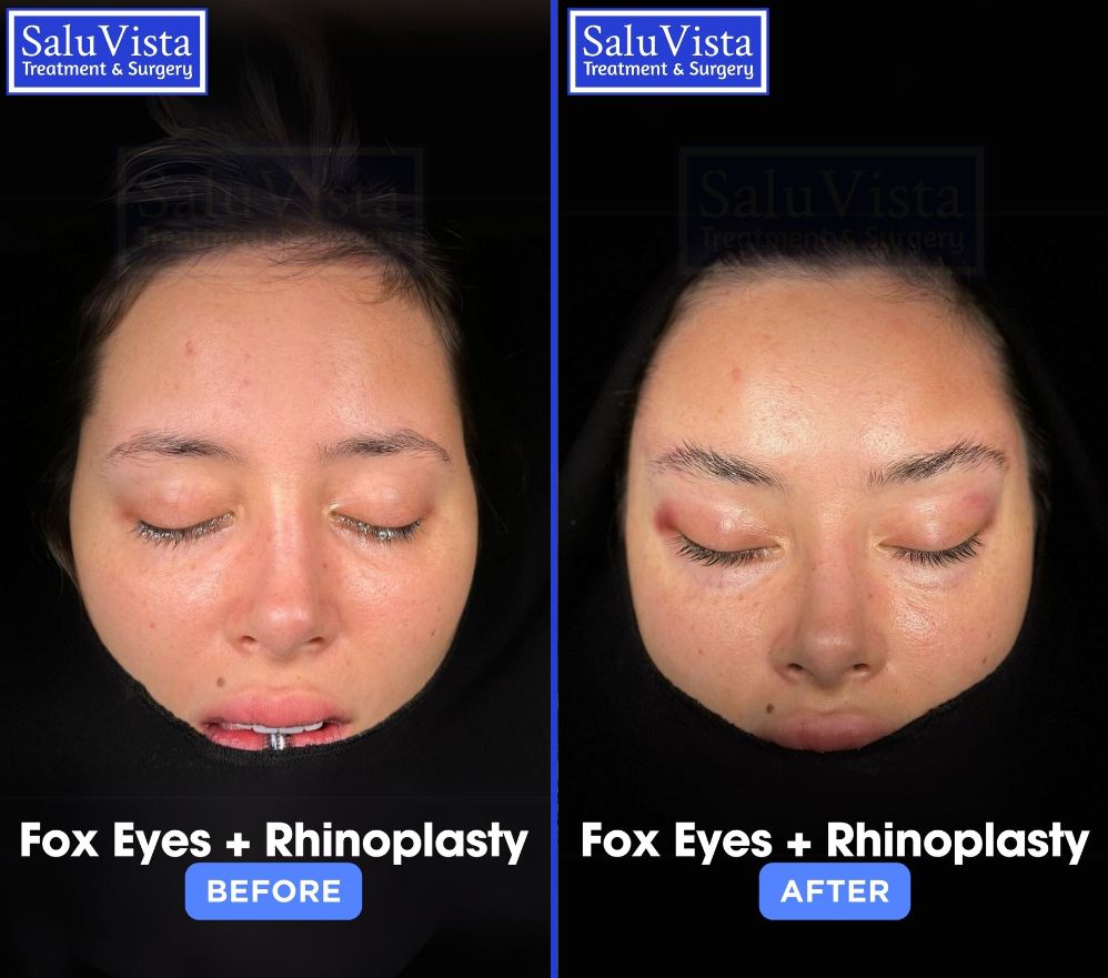 Fox eyes + rhinoplasty before and after result
