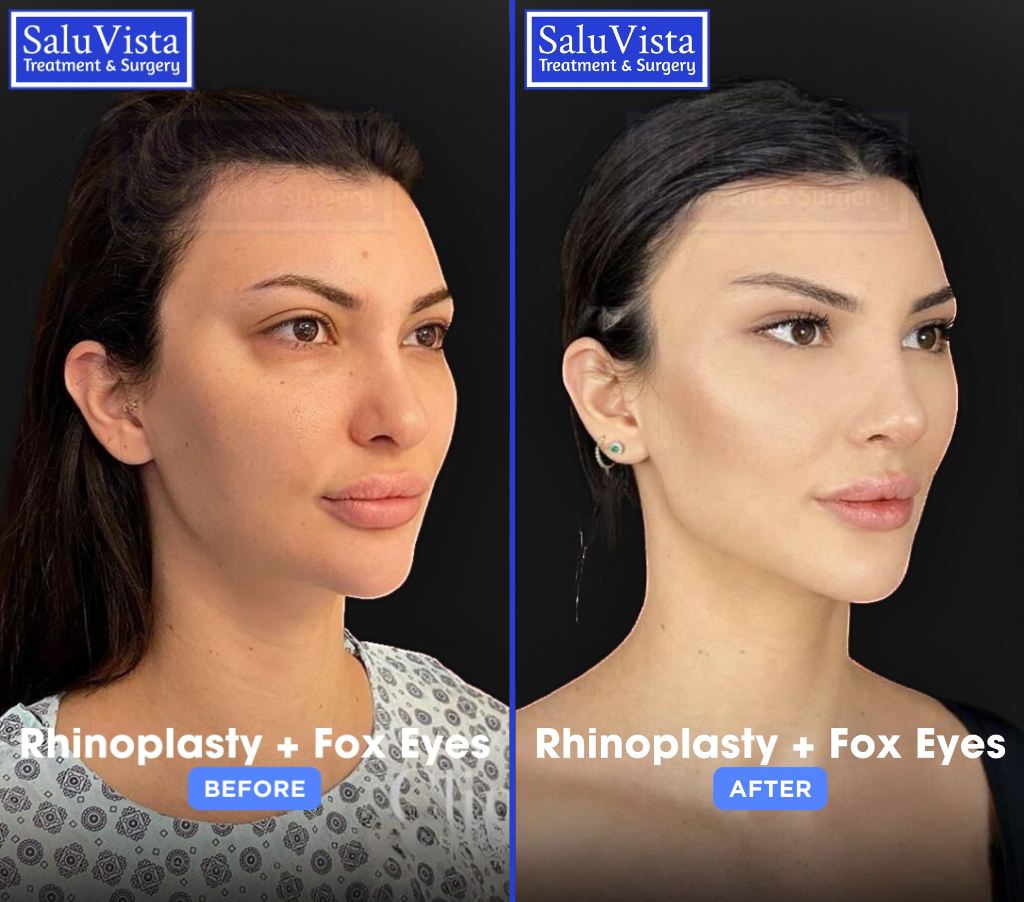 Fox eyes + rhinoplasty before and after result