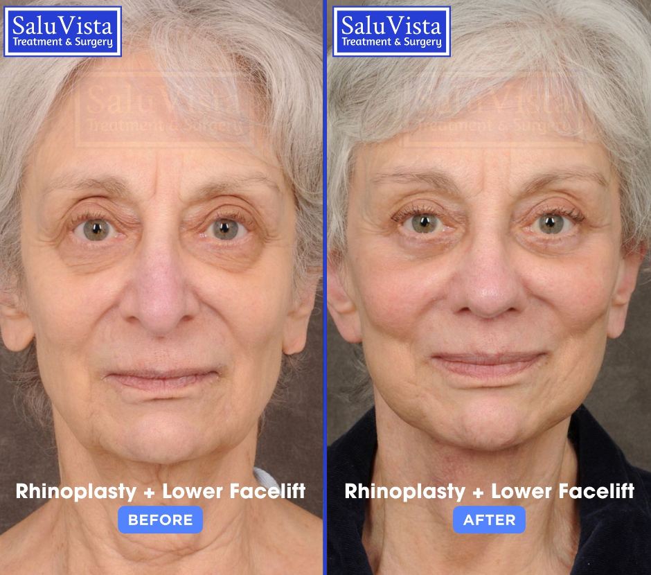 Rhinoplasty + lower facelift before and after result