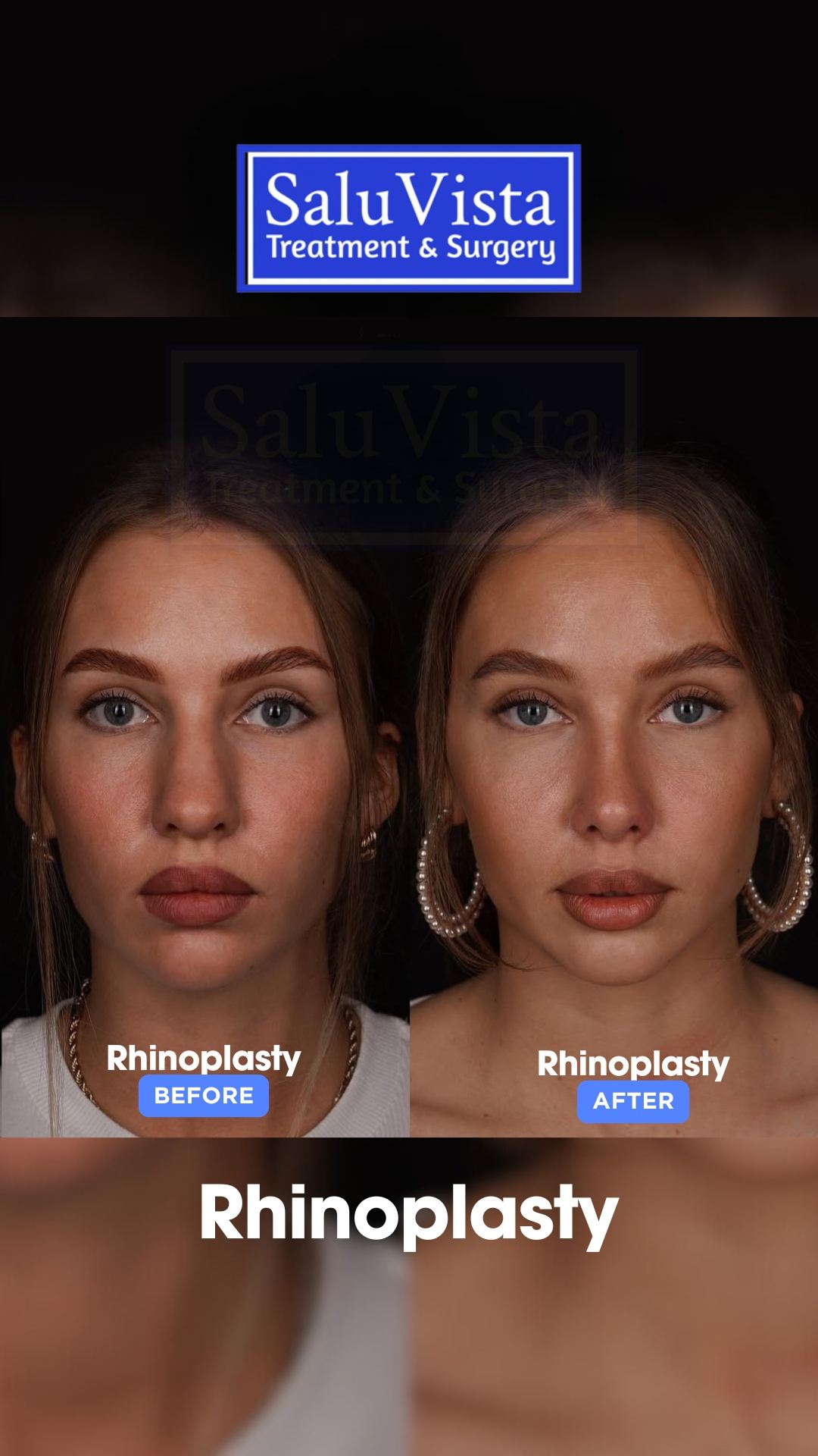Rhinoplasty before and after result