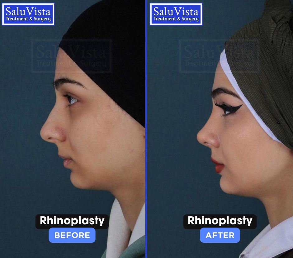 Rhinoplasty before and after result
