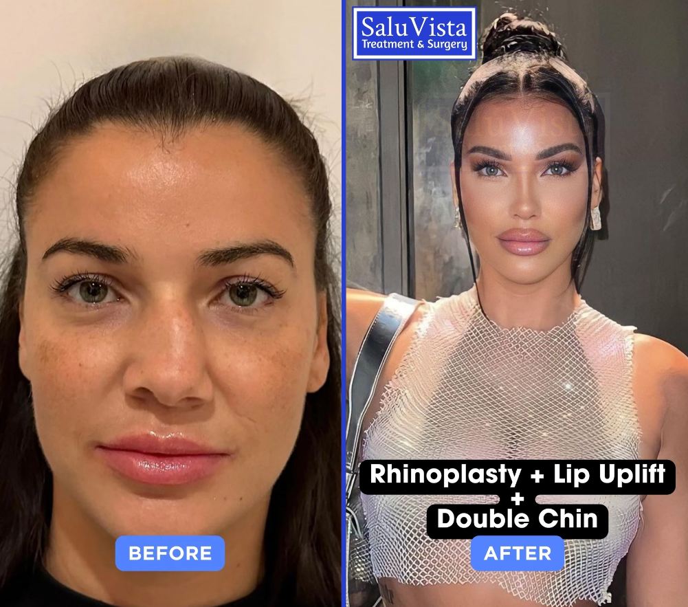 Rhinoplasty + lip lift before and after result
