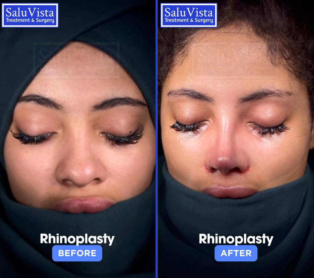 Rhinoplasty before and after result