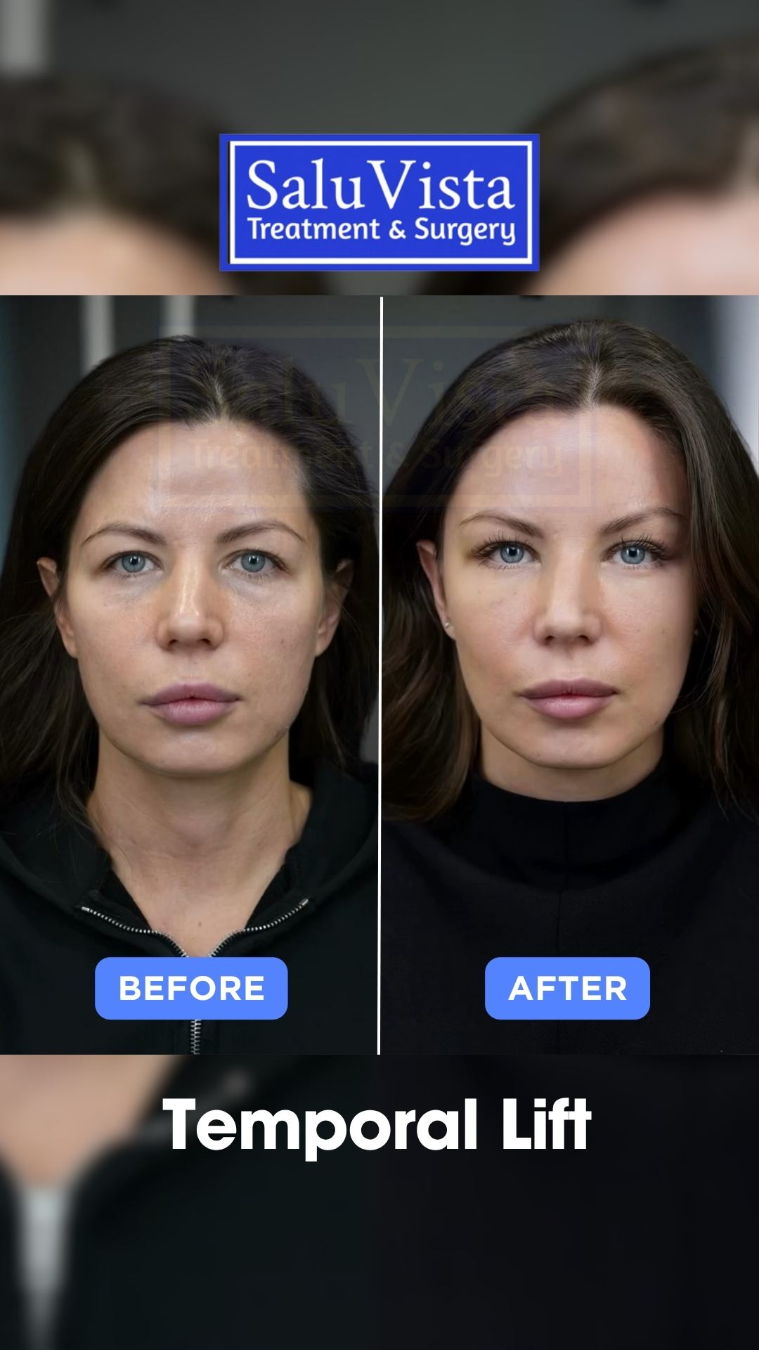 Temporal lift before and after result
