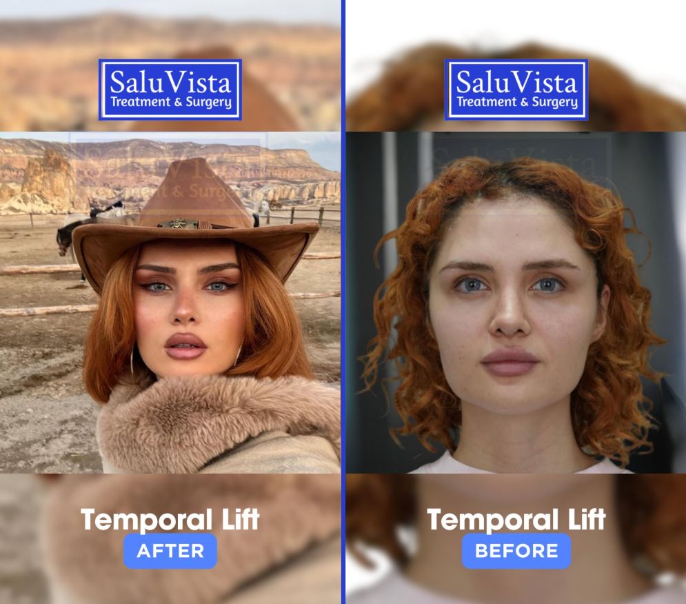 Temporal lift before and after result