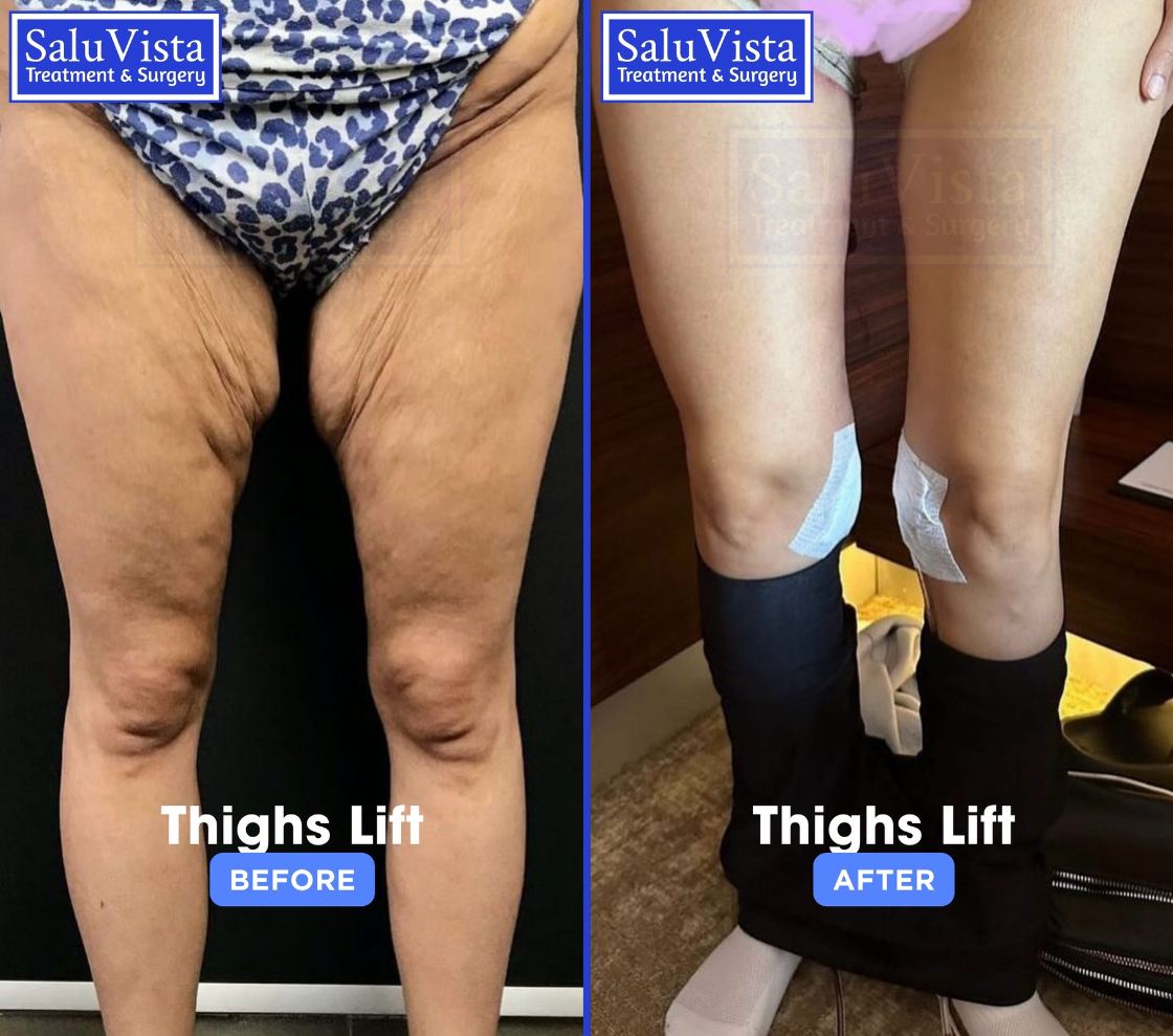 Thigh lift before and after result