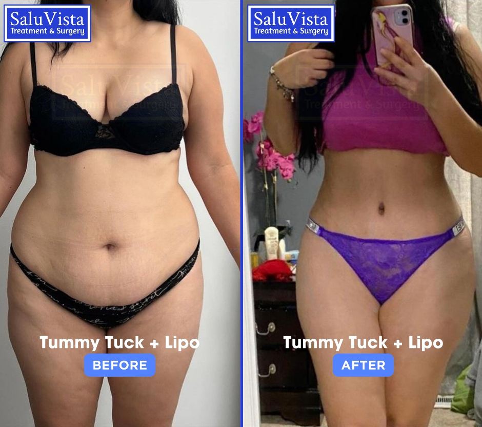 Tummy tuck + liposuction before and after result