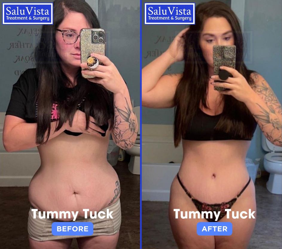 Tummy tuck before and after result