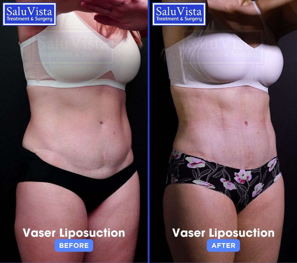 VASER liposuction before and after result